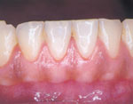 初期の歯周病～軽度の炎症